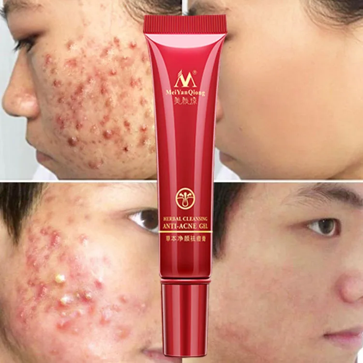 Hot Selling More Effective Aloe Acne Cream Acne Removal  Cream