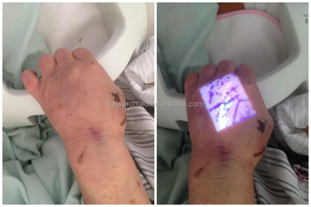 Professional Medical Devices vein finder viewer locator for sclerotherapyClinical Analytical Instruments