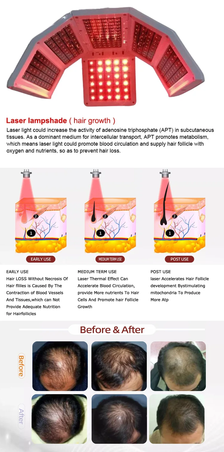 Low laser Hair Regrowth Hat Oil Control And Anti-shedding Red Light Helmet Laser Growth Hat Pdt Laser Cap Device