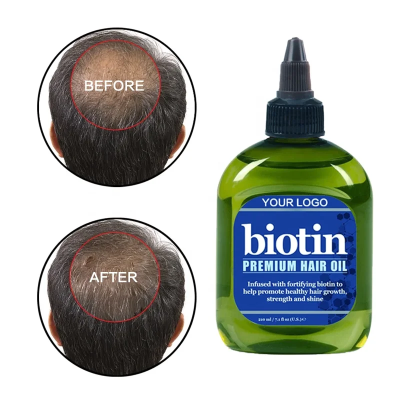 TOP Selling 30 DAYS Men Hair Loss Treatment Natural Biotin Hair Oil Prevent Scalp Loss Regrowth Oil Serum