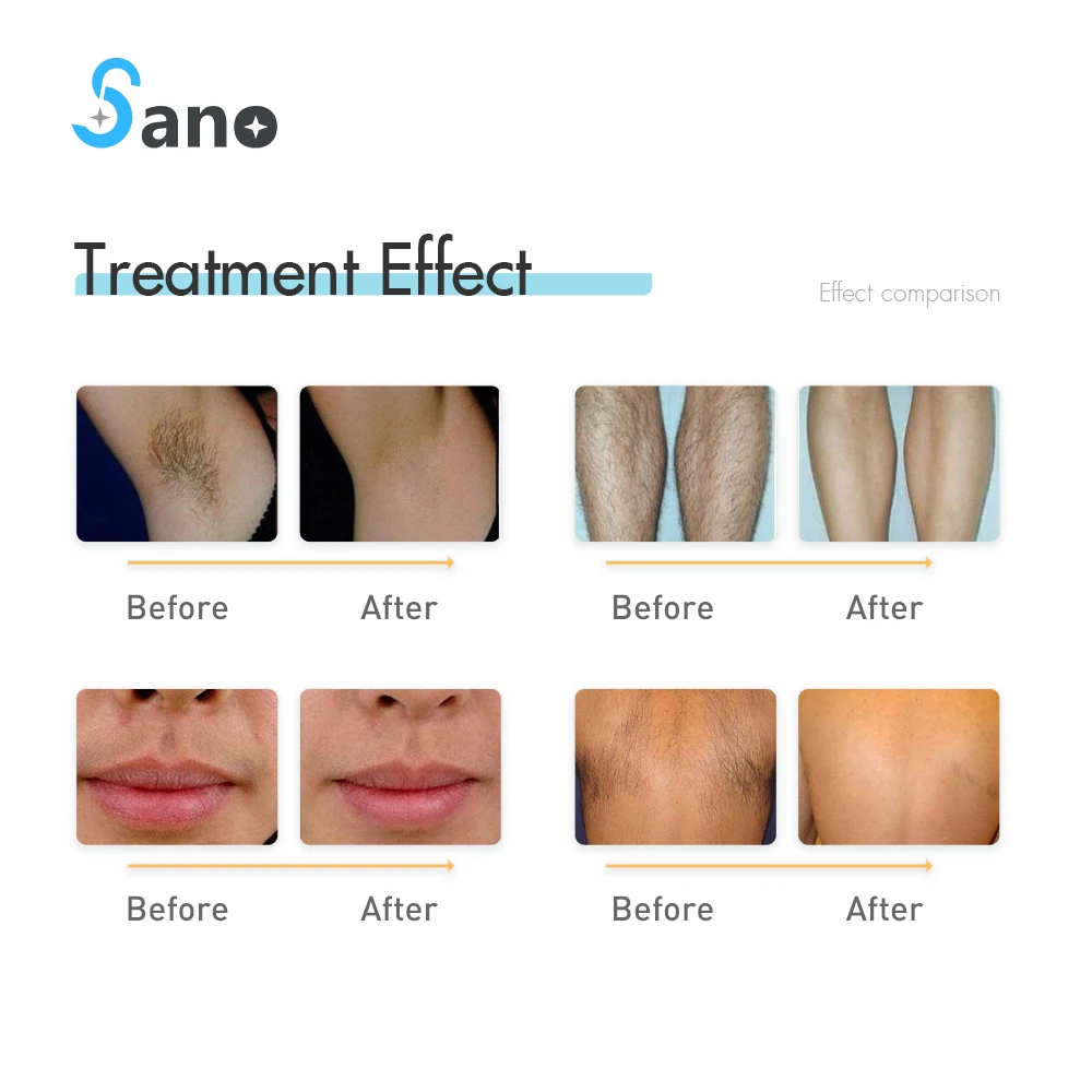 2024 best diode laser hair removal 755 + 808 + 1064nm wavelength 3 in 1 laser hair remove machine