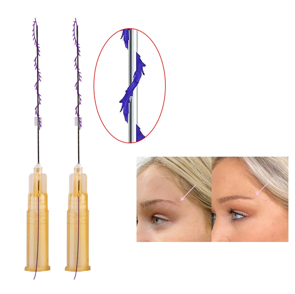 Korea 25g 38mm Neck Tightening Absorbable Barbed Face Lifting Hilos Mini Cog Screw Pdo Thread