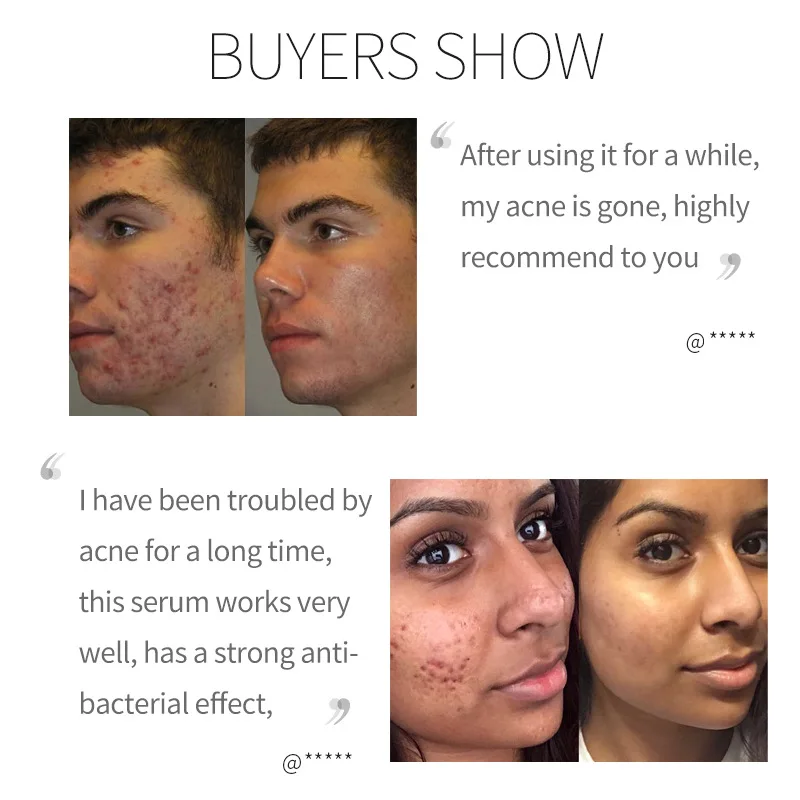 Relax, Lift, Tighten and Improve Wrinkles Azelaic Acid 10% Facial Essence