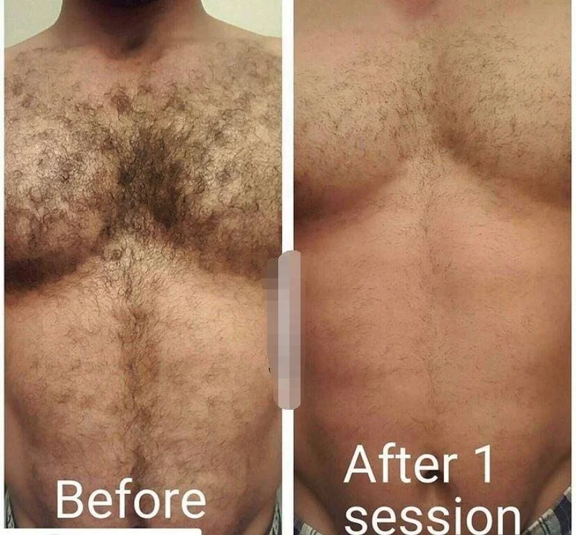 2022 CE approved diode laser hair removal system 755 808 1064nm for hair removal free training 3 years warranty