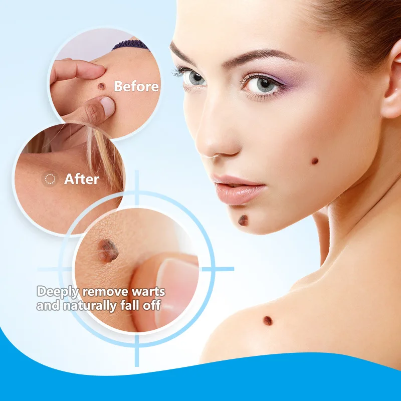 20g Warts Remover Ointment Wart Treatment Cream Skin Tag Remover Herbal Extract Corn Plaster Warts Ointment