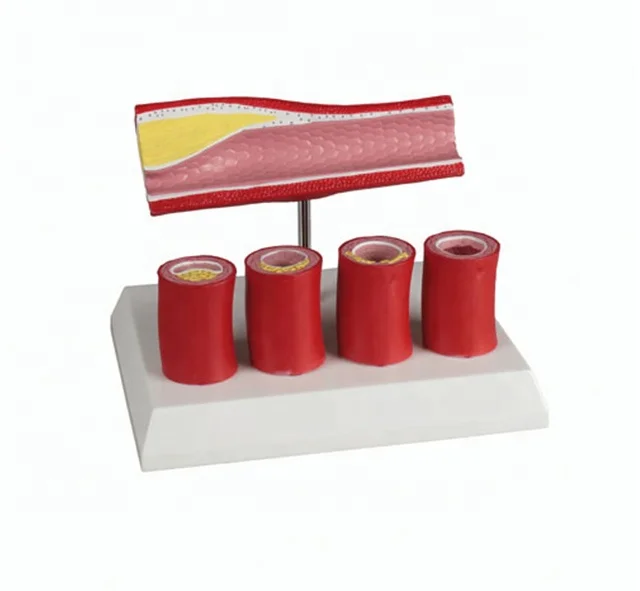 YA/C017A Factory price medical discipline coronary atherosclerotic with thrombus model anatomy teaching laboratory equipment