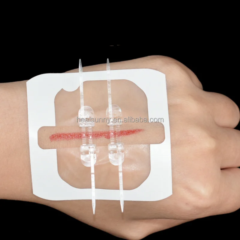 Medical devices Non-invasive Adhesive Wound Closure Zipper