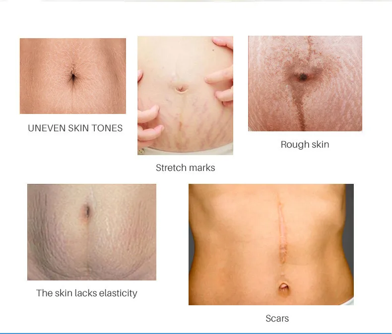 Private Label OEM Customization Repair Stretch Obesity Massage Oil stretch mark oil