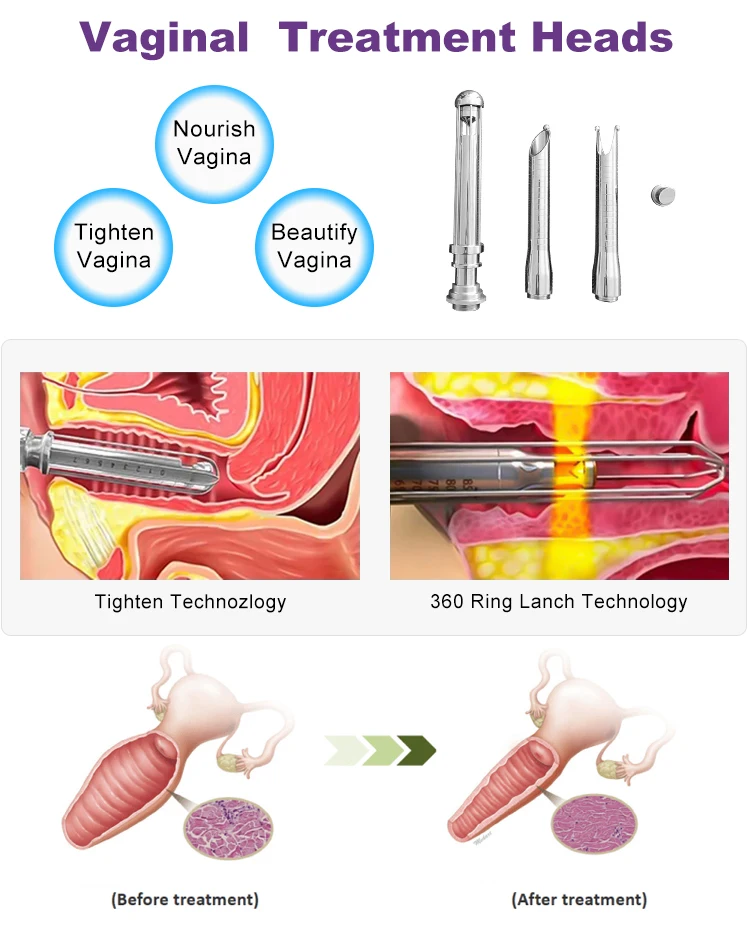 co2 laser system laser vaginal tightening and rejuvenation wand nd yag laser
