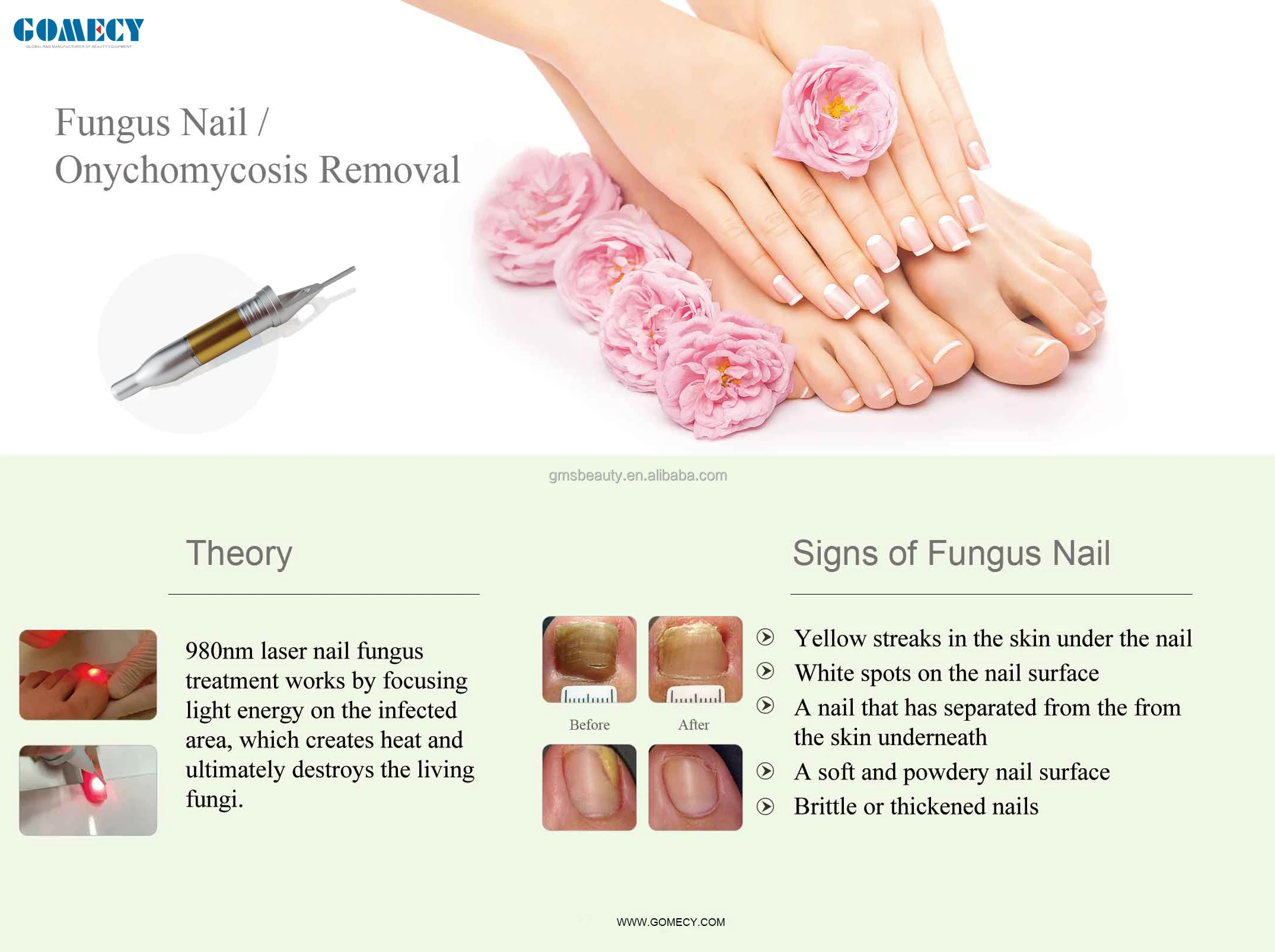 New invention product 980nm 905nm laser toenail nail fungus treatment machine