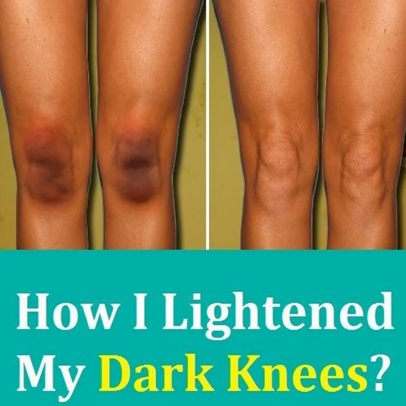 Сыворотка для быстрого отбеливания темных суставов корректор пигментации сыворотка удаления рук локтей колена интенсивных пятен