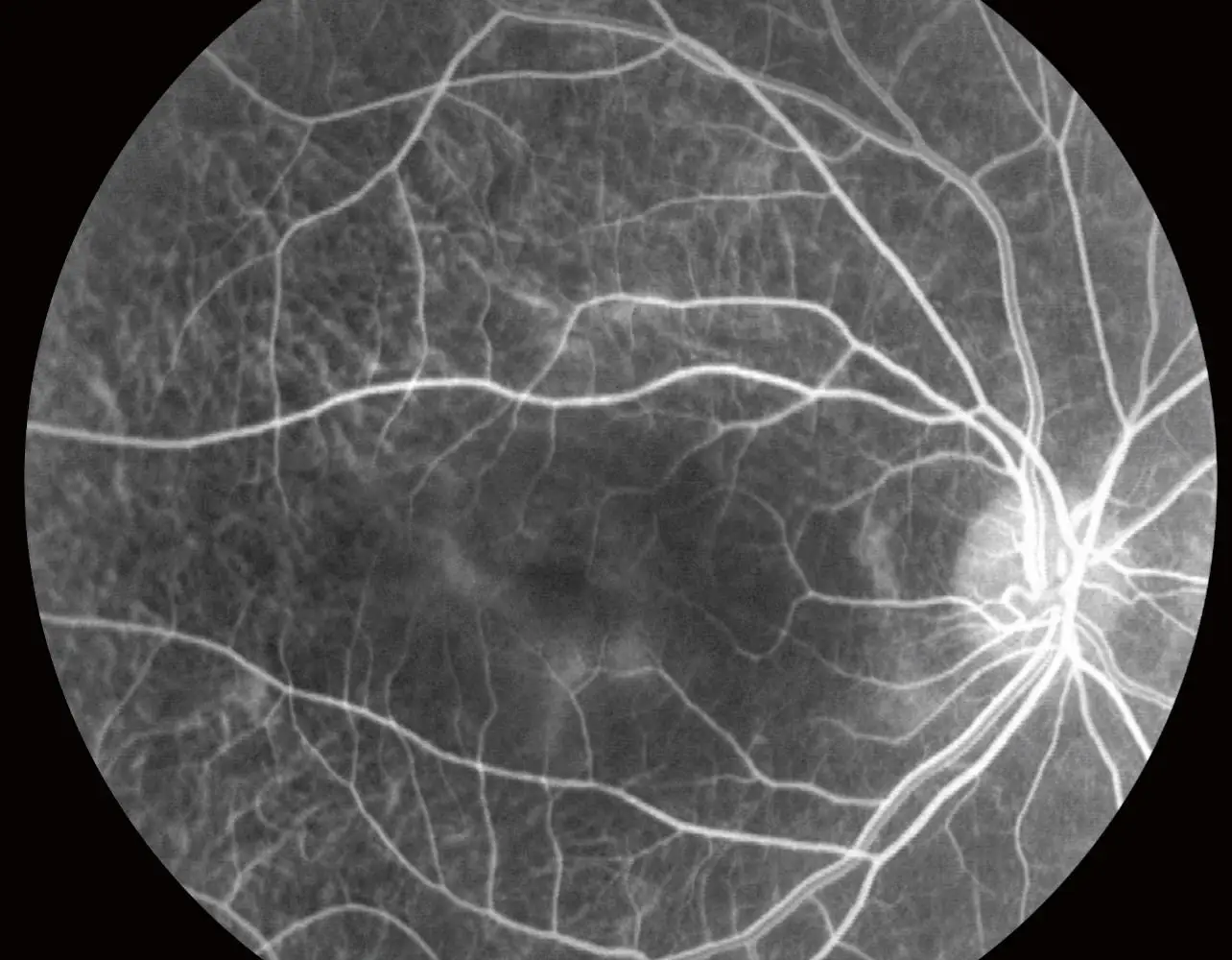 Factory Supply Aer Non Mydriatic Camera Fundus For Sale
