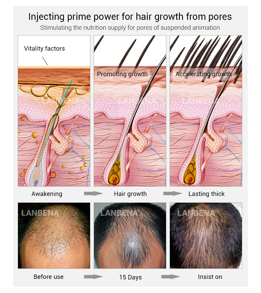 LANBENA Fast Powerful Hair Growth Essence Products Essential Oil Preventing Hair Loss Hair Care Andrea 30ml