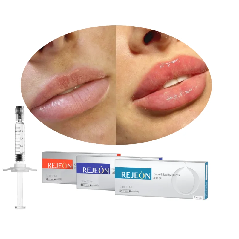 REJEON Dermal Filler For Lips Private Label Nano Needle Brand Dermal Elasty Dermal Filler Ce