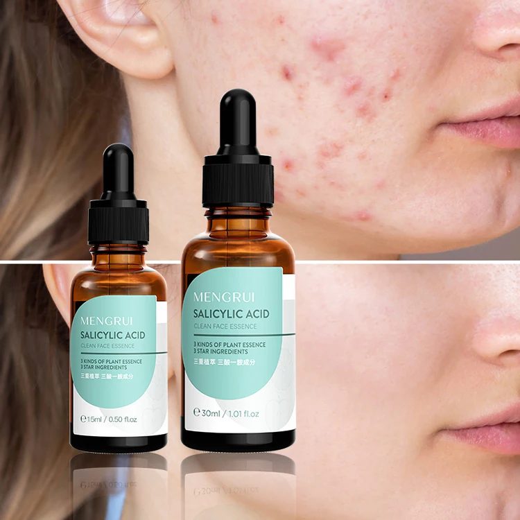 Custom Logo Oem Salicylic Acid Skin Acne Removal Face Serum For Acne