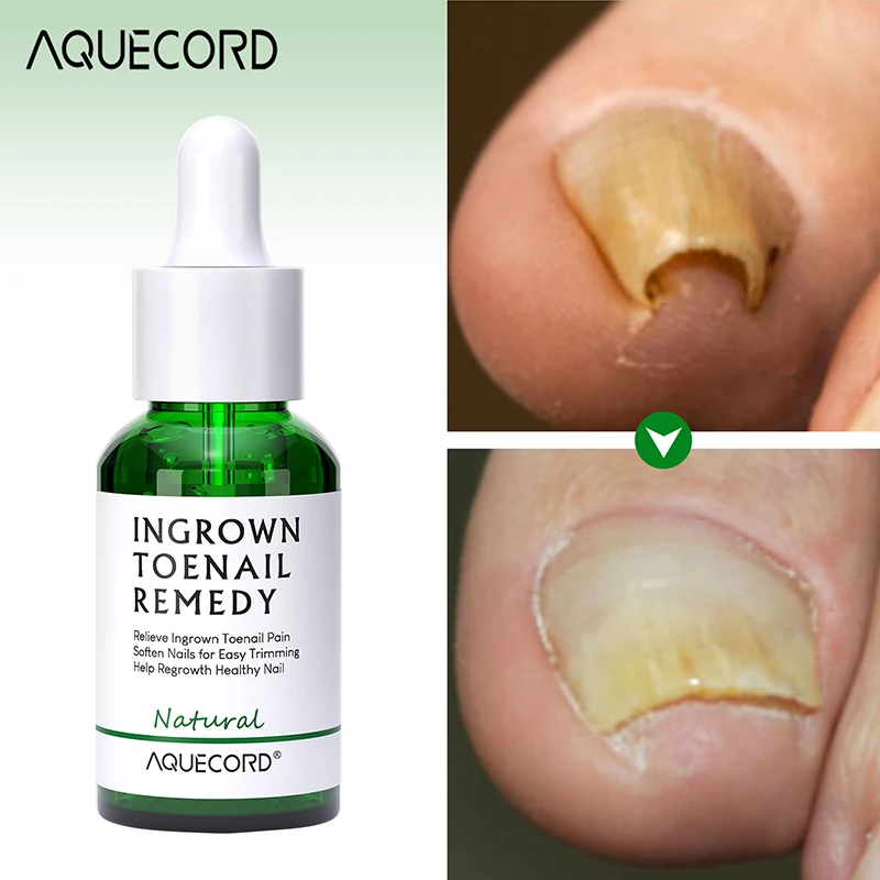 Private Label Nail Treatment Oil Anti Infection Paronychia Onychomycosis Feet Care Nail Fungus Removal Gel Care
