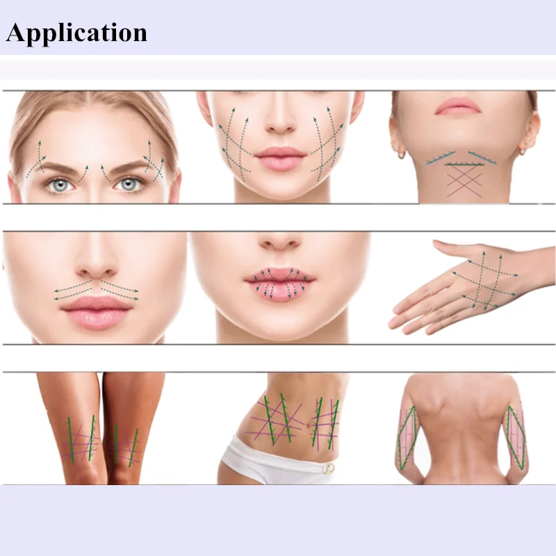 China Supplier skin rejuvenation absorbable v line hilos pdo collagen 4d cog threads