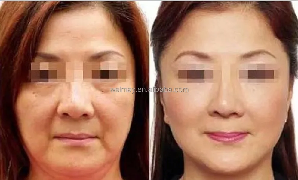 7 Tips 1MHZ RF Radio Frequency Machine Monopolar RF Face Skin Tightening Radio Frequency Ablation Beauty Device