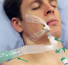 72 hours  Medical Closed Suction Catheter System For Tracheal  tube