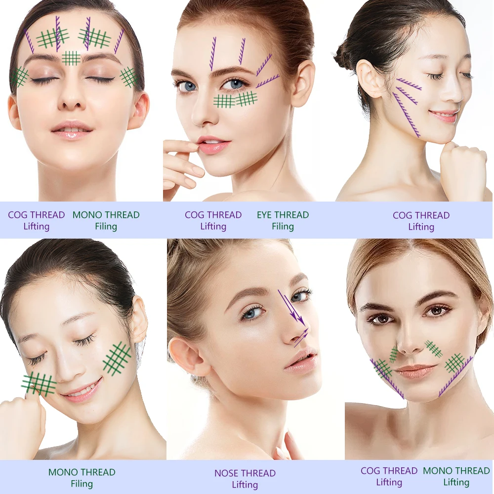 2021 Горячая продажа Cog 3d W иглы 21g 100 мм Pdo Cog нитки Барб