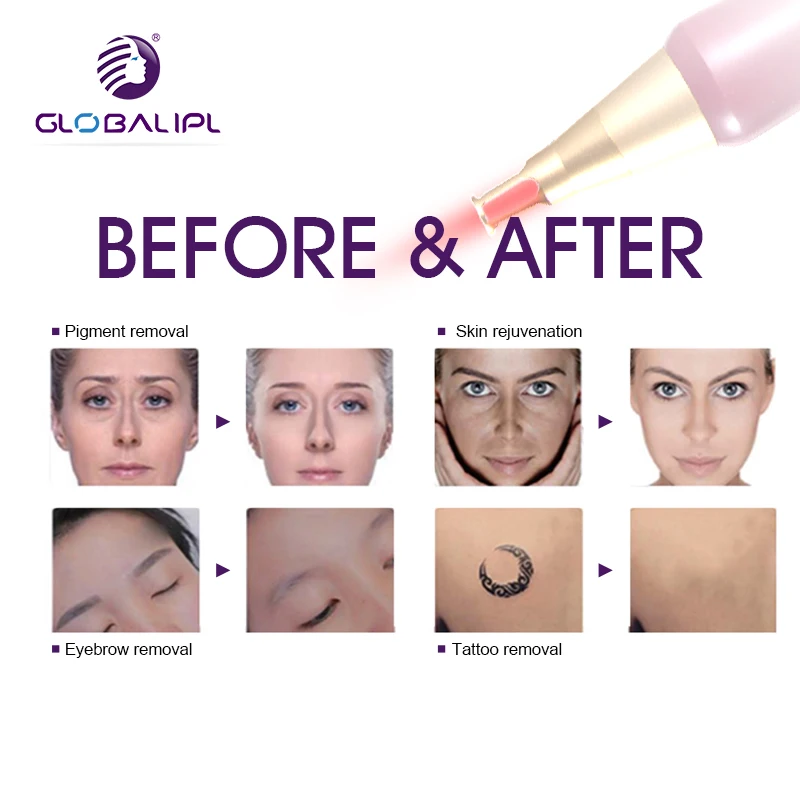 755nm Oem / Odm 15hz Picosecond Tattoo Removal Q Switch Nd Yag Pico Second Laser