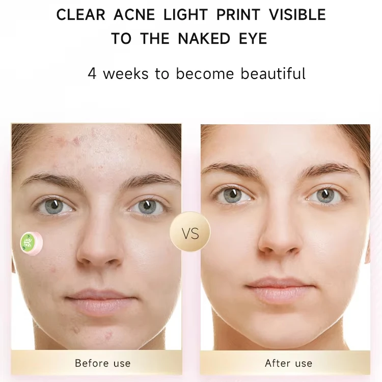 LED red light acne patch calm light acne printing beauty instrument tender skin instrument Acne Treatment