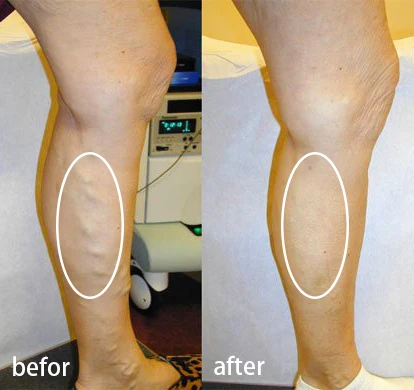 2024 Dual-Wavelength Operation 980nm & 1470nm Shaping Health Blood Vessels EVLT Varicose Veins Treatment doctor use device