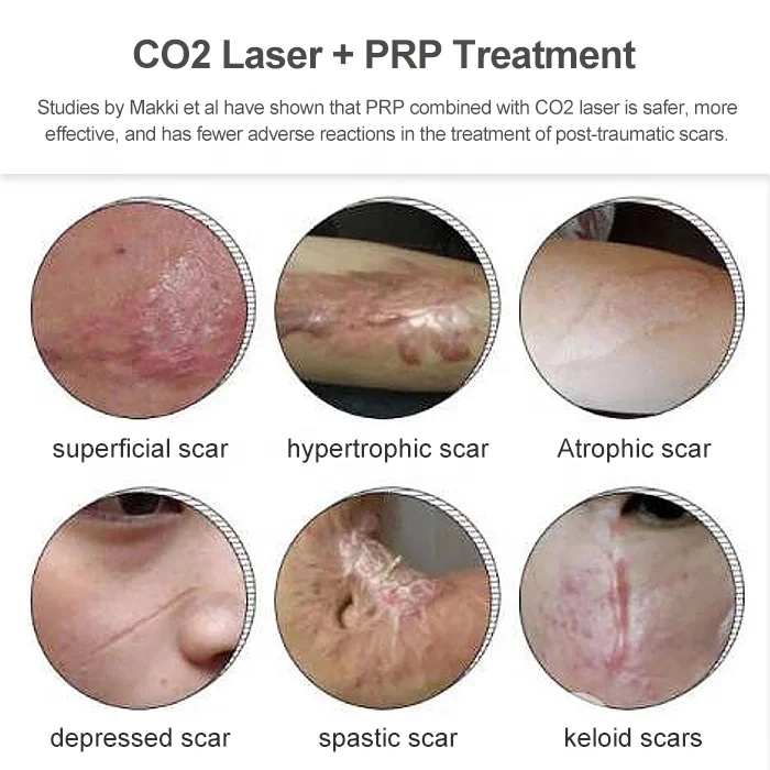 New PRP tube with Gel For Hair Loss Beauty Face Aethestic Clinic Skin Care and Dental Use