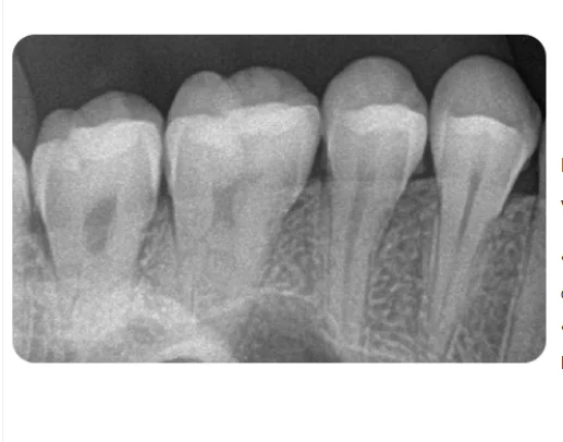 Dental equipment Portable high Frequency Intraoral X-ray Unit Digital Dental X-Ray machine Price