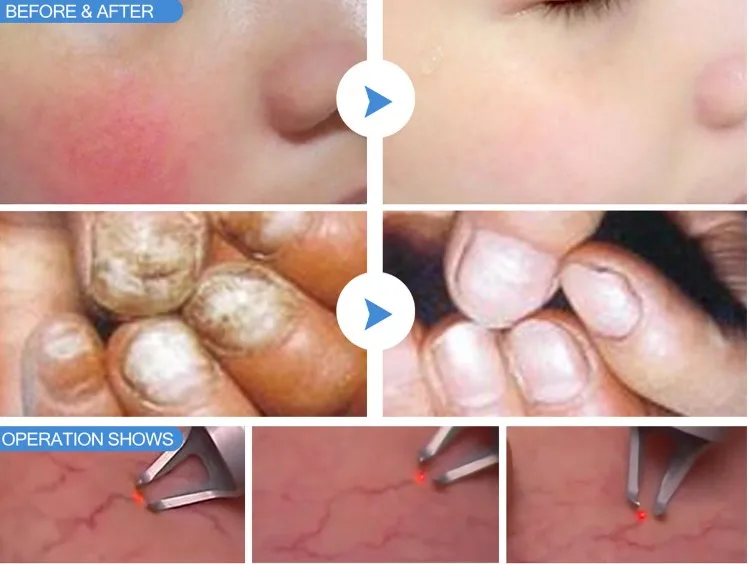 30w 980 nm diode laser vascular removal machine multi functional 1470nm 980nm diode laser with medical CE