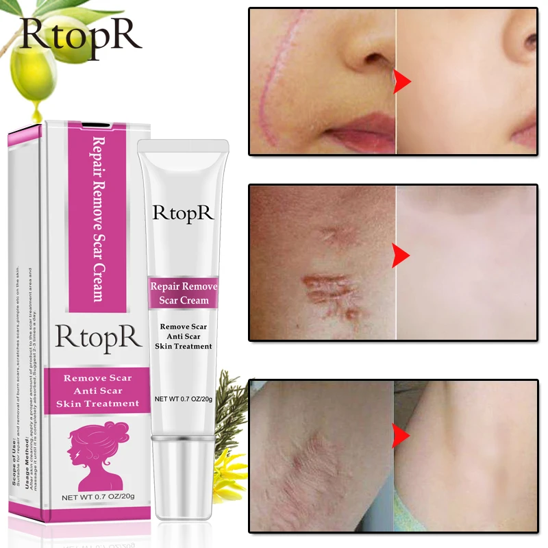 Good effect  removal scar anti scar  Acne Scar Removal Cream skin care treatment