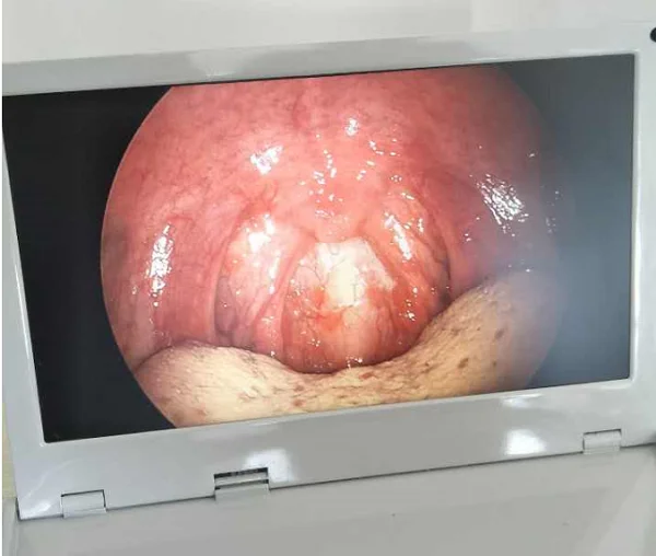 Медицинская интегрированная хирургическая камера-эндоскоп с монитором