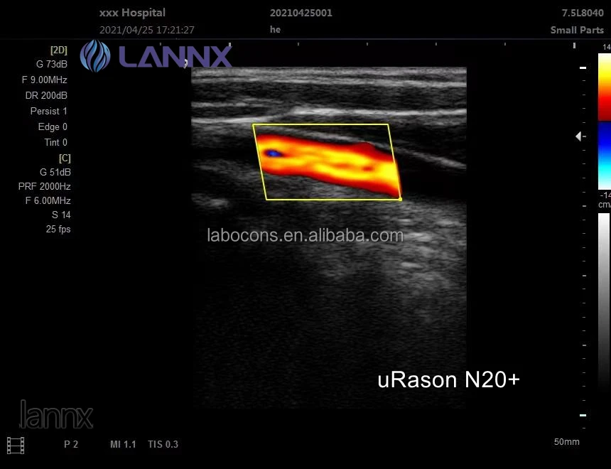 LANNX uRason N20+ Best Quality human Diagnosis echocardiography machine Medical pregnancy black / white ultrasound Instrument