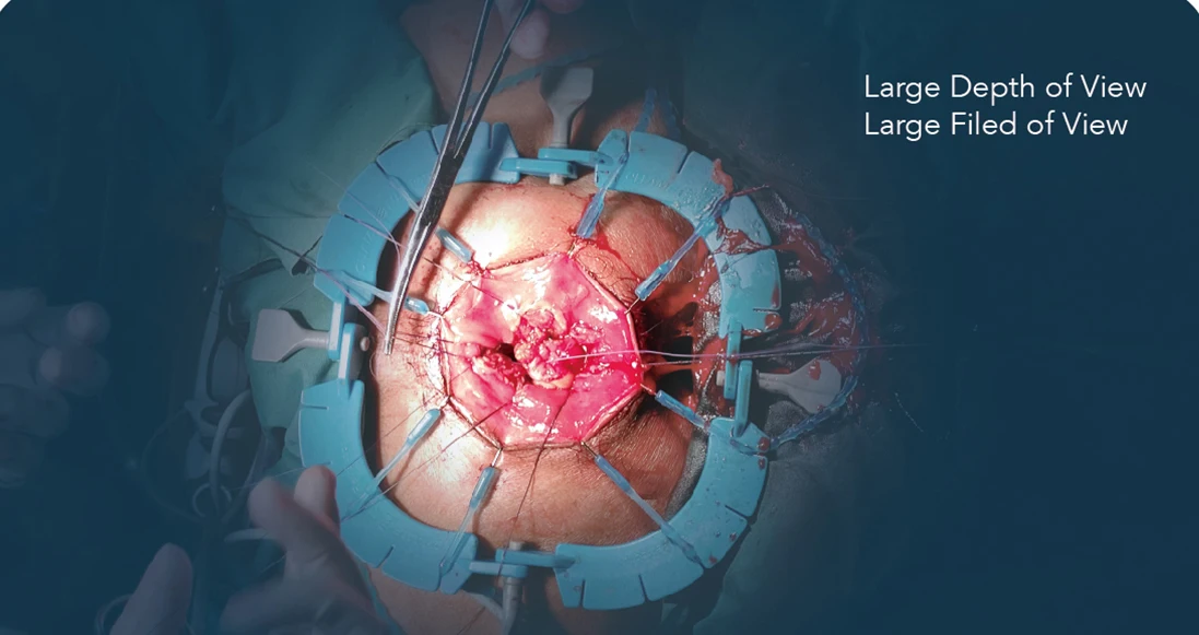 Medical Vaginal / Abdominal / Laparotomy/ Laparoscopy/ Gynecological Surgery Surgical Ring Lone Star Retractor