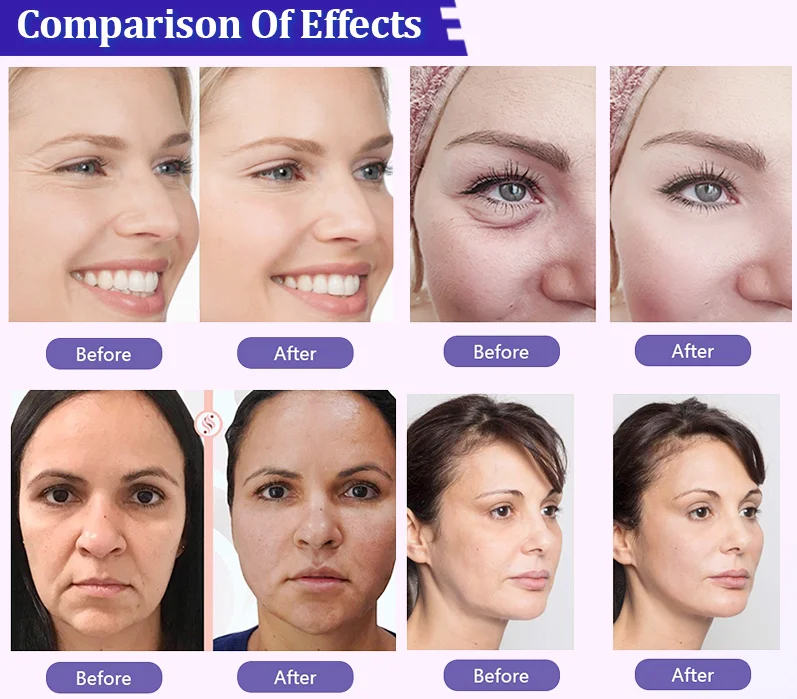 Double Needle Pdo Pcl Plla Thread Nose L Blunt Multi L Fish Bone L/W Blunt Molding Cog Pcl Mesh Thread for Facial Body Lifting.png