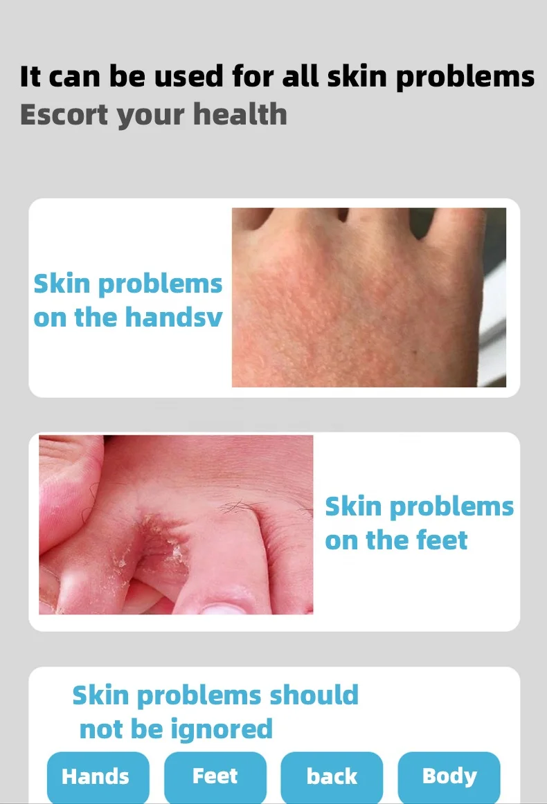 Anti-inflammatory Itching Relieve Skin Herbal  Disease Relieve Itching Pruritus Psoriasis Cream Ointment