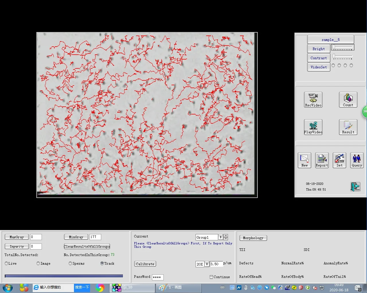 High accuracy Automated Sperm Quality Analysis System/sperm analyzer price/Laptop trolley computer assisted semen analysis