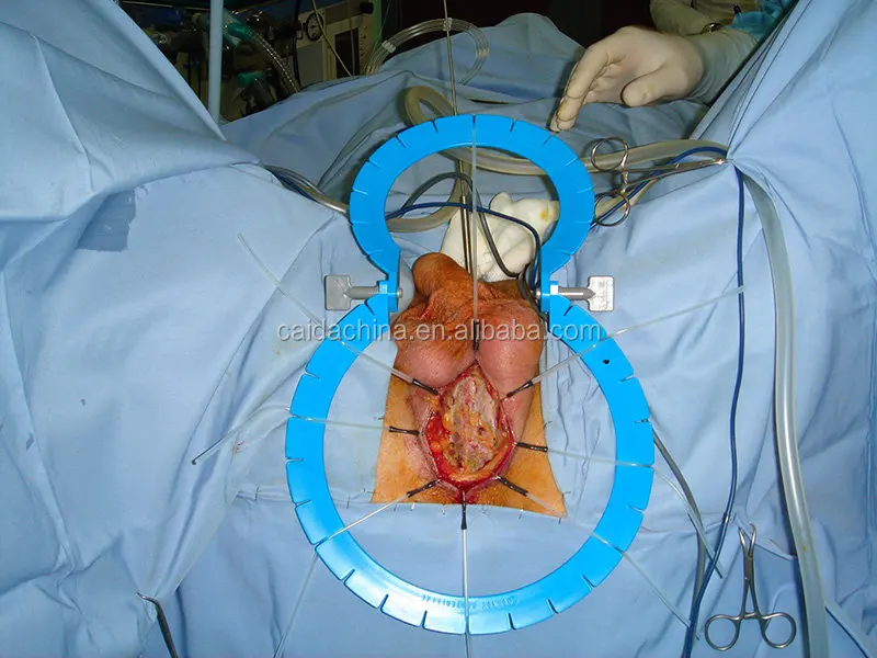 Highest Quality Gynecology retractor Reusable Retractors disposable retractor ring manufacturer and supplier