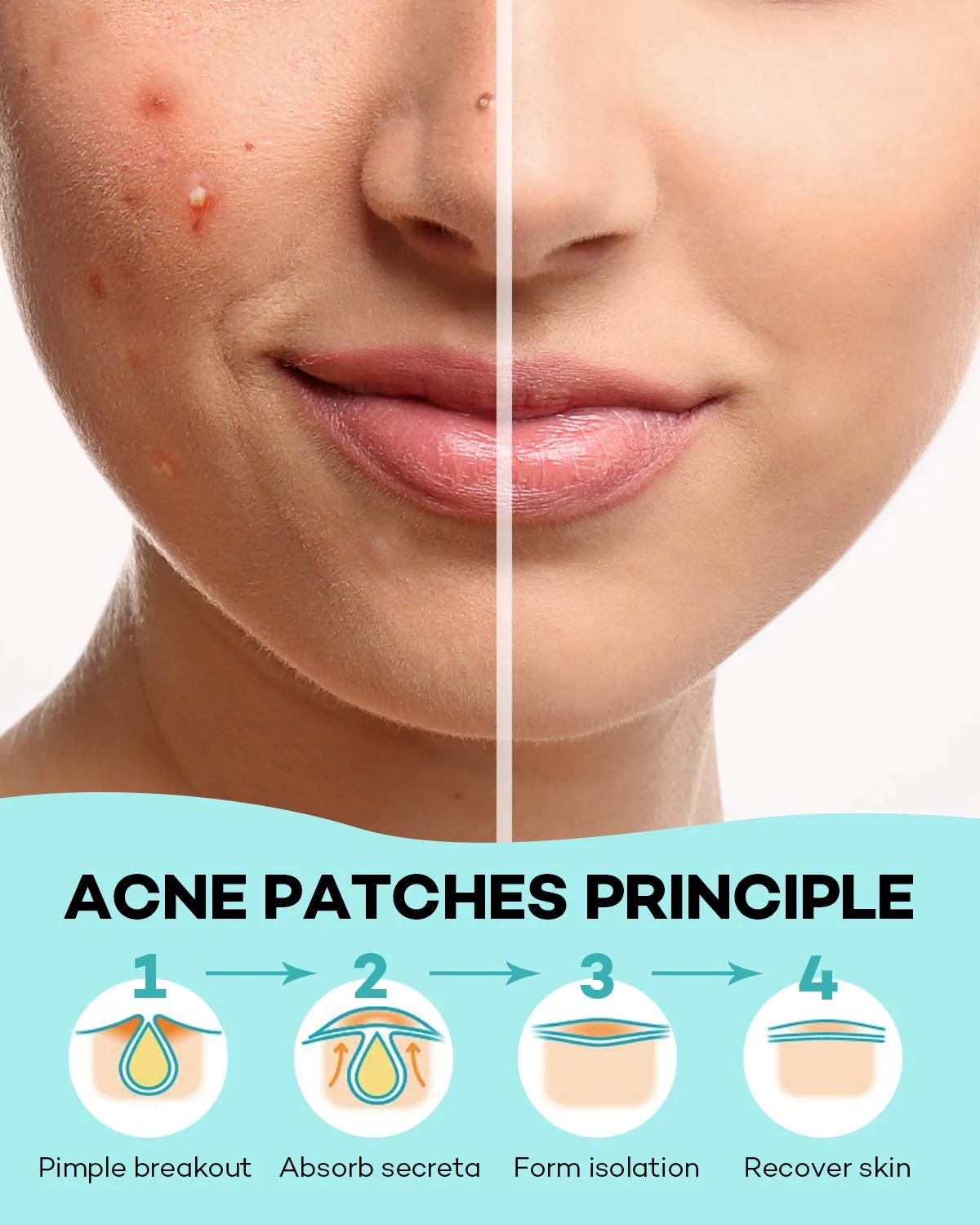 Invisible acne removal acne stickers blemish face skin care pimple remover tool for daily use