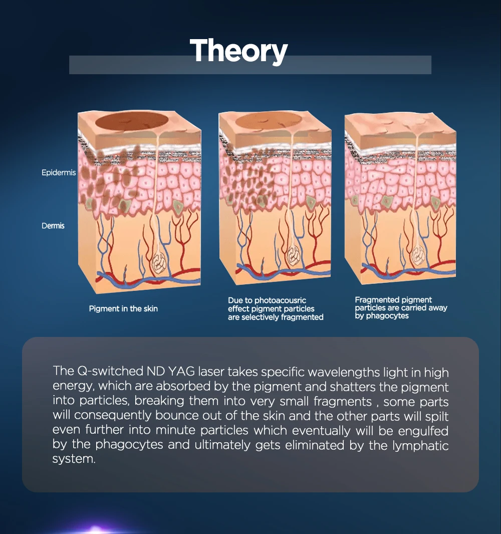 ADSS Best Sellers Q Switched Skin Tag Removal 1064nm 532nm Nd Yag Laser Tattoo Removal  Machine