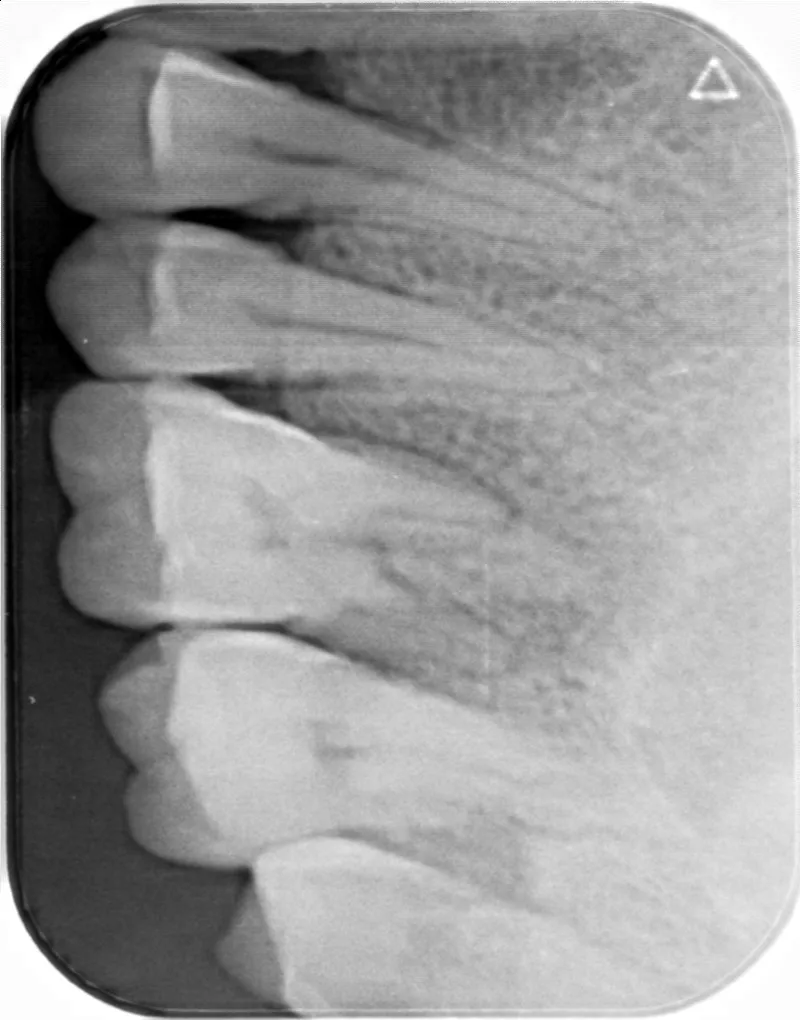 Wholesale Price Cheap Dental PSP Phosphor Plate Scanner For Imaging 2# Phosphor Plate Film Included