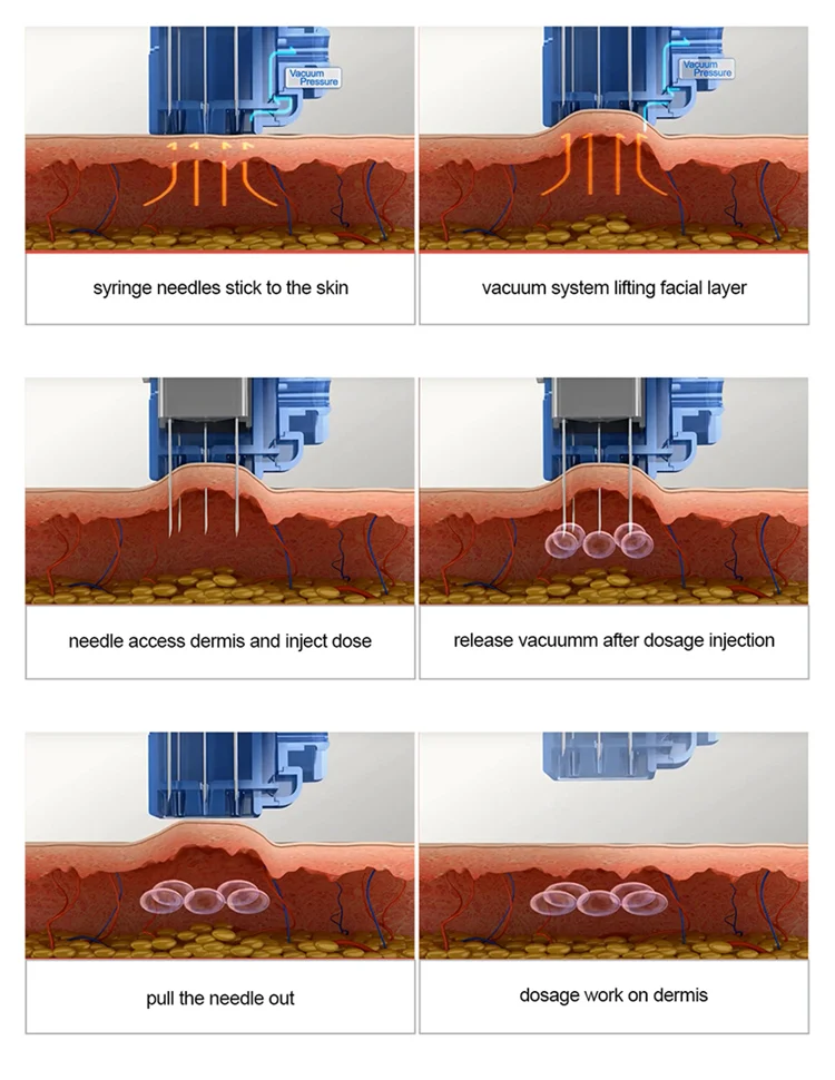 mesotherapy injector facial moisturizing negative pressure injection  multi meso gun needle injector new 2023