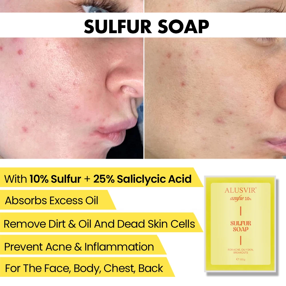 10% Sulfur 25% Salicylic Acid Anti Acne Treatment Skin Body Care Anti Acne Face Body Bathing Soap Bar Manufacturers Wholesale