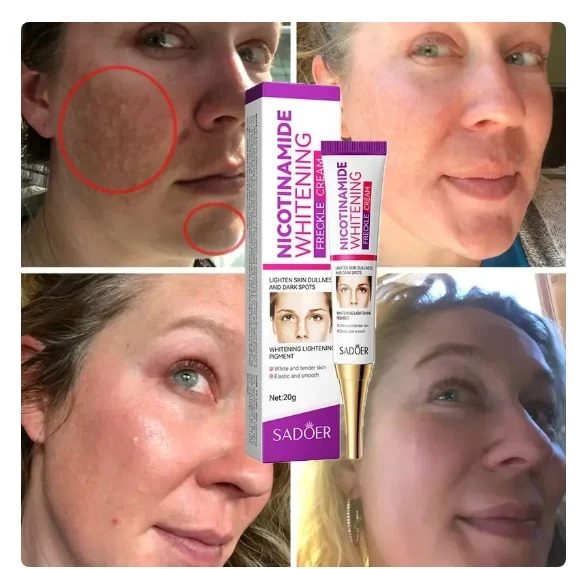Whitening Cream Repairing Freckle Pigmentation Improving Dark Yellow Smoke Amide Reducing Melasma Facial Whitening Cream