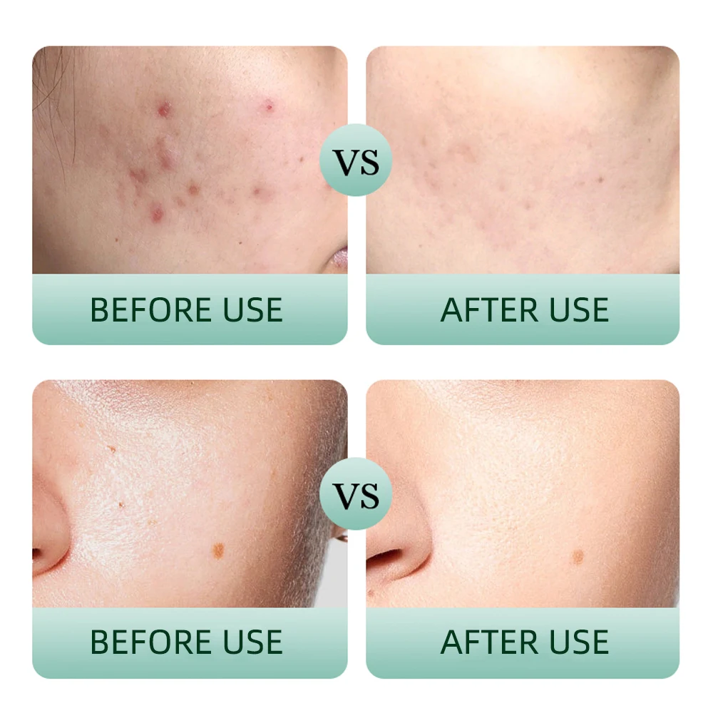 OEM Private label Wholesale Tea Tree Oil Control Skincare Set Anti Acne Cosmetics 4 Piece Facial Care Set