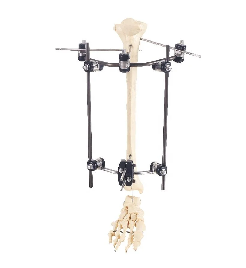 
Medical Bone Surgery Orhtopedic Combinational External Fixation Stent for Leg Fracture 