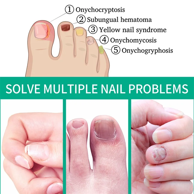 Organic Fungus Nail Repair Essence Toe nail Fungus Remover Treatment Solution