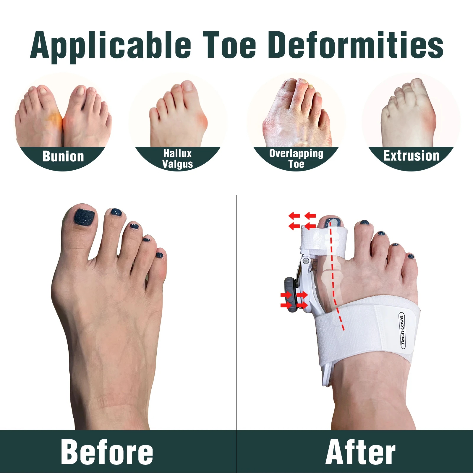 2 in 1 upgraded double-stitched loops gel toe separators bunion corrector sleeve pads for bunions