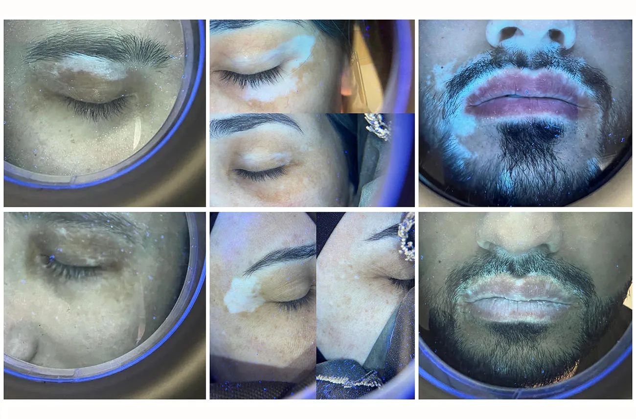 Kernel Wood Lamp Skin Testing Tool UV Lamp for Skin Magnifying Analyzer Machine Wood Lamp Skin Analyzer