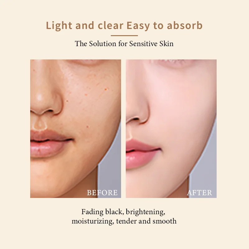 Cream for pimples  pimple remover  Shea Butter Vitamin E Salicylic Acid Carnosine Face Whitening Cream